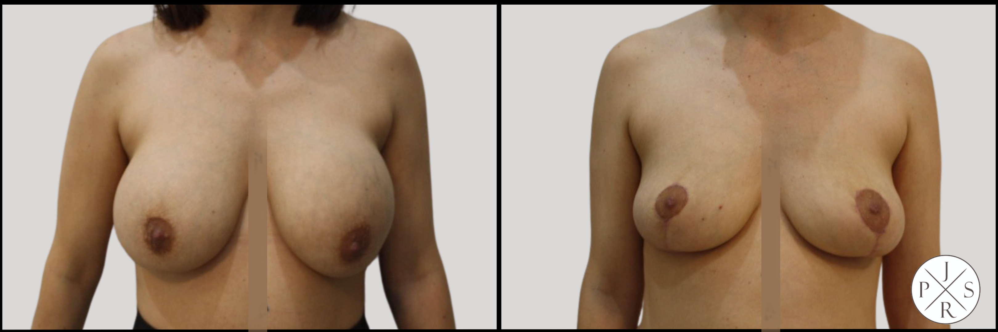 Breast Implant Removal Before & After Image